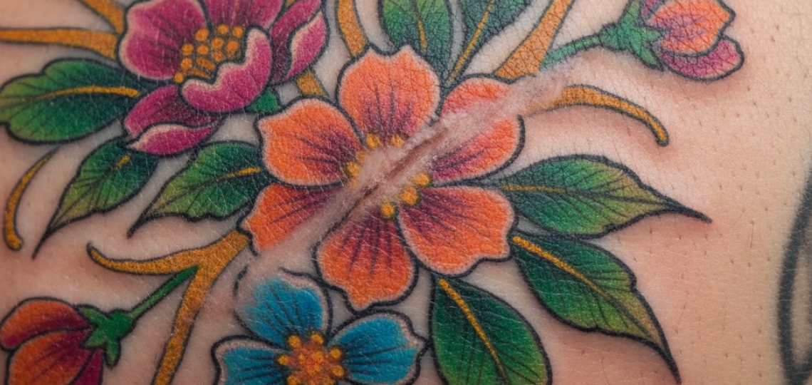 tatuar-sobre-cicatrizes-e-seguro.png